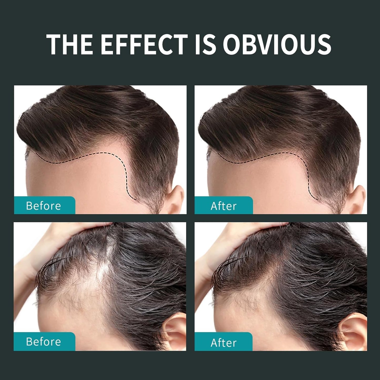 Sevich Hair Fiber Spray - Instant Hair Thickening Powder for Men & Women, Hair Building Fibers for Thinning Hair, Root Touch Up Hair Color, Waterproof, Sweatproof, Natural Look,120ml Dark Brown