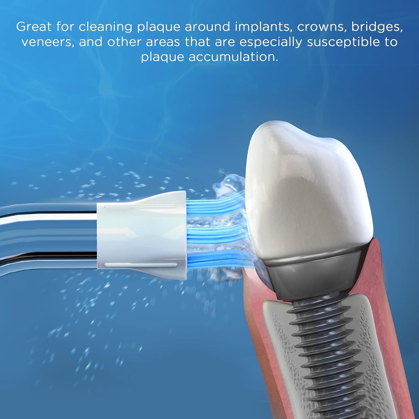 Replacement Tips for Waterpik Water Flosser(6 Plaque Chaser Tips & Storage Case Bundle)